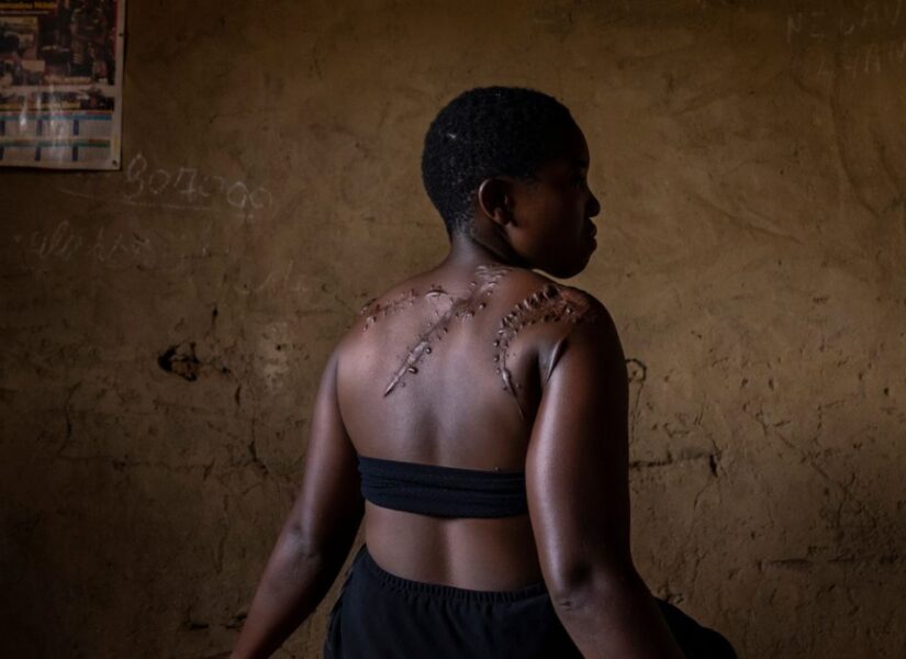 Georgette Ndovya Kavugho, 32 anni, posa per un ritratto il 6 aprile 2021 a Mbaou, Beni, Repubblica Democratica del Congo. Georgette Ndovya Kavugho è stata aggredita da membri del gruppo islamista ADF nella sua casa il 16 novembre 2019. L'hanno colpita con dei machete, lasciandole profonde ferite alle braccia e alla schiena, e l'hanno infine lasciata per morta mentre continuavano a saccheggiare il suo villaggio.